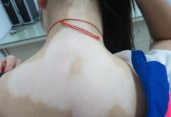 The Regular Acknowledge of Vitiligo —— Part IV