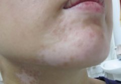 The Regular Acknowledge of Vitiligo —— Part III