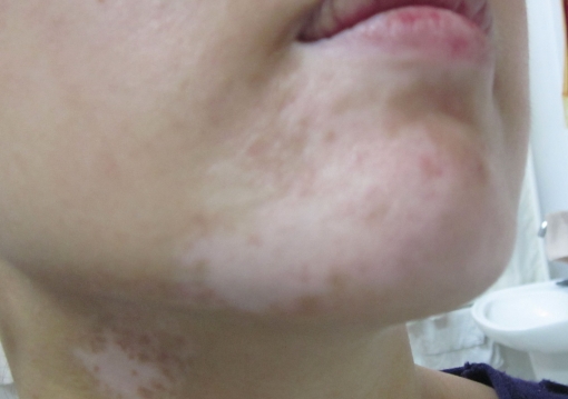 The Regular Acknowledge of Vitiligo