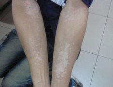 The Regular Acknowledge of Vitiligo — Part II
