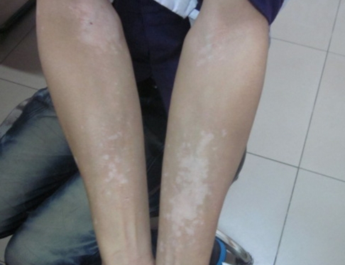 The Regular Acknowledge of Vitiligo