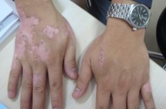 The regular acknowledge of vitiligo