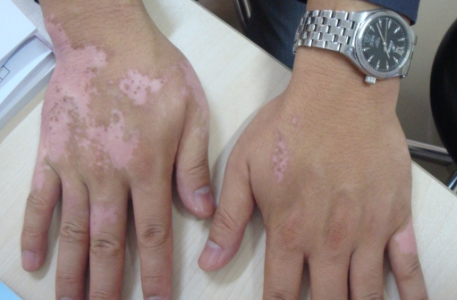The Regular Acknowledge of Vitiligo