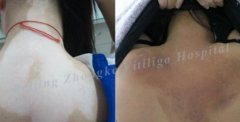 Does the Vitiligo Will Rebound Again after Cured