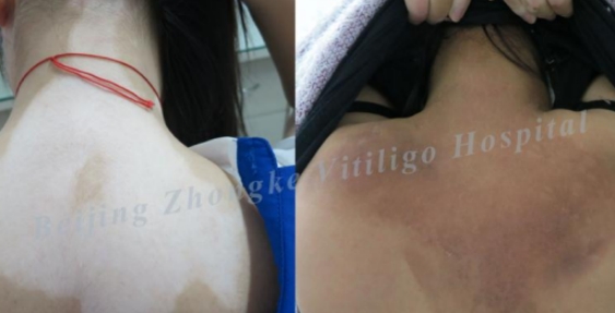 Does the Vitiligo Will Rebound Again after Cured