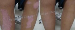 What is The Isomorphic Reaction of Vitiligo
