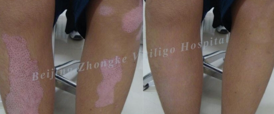 What is The Isomorphic Reaction of Vitiligo