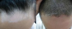 Catching a Cold Might Cause Vitiligo Worse