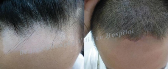 vitiligo casues 