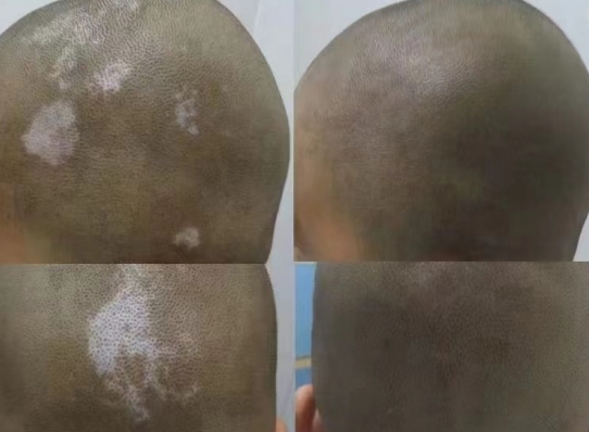 vitiligo