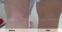 The Relation Between Vitiligo and Immune Function
