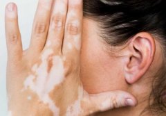 Five theories about vitiligo causes