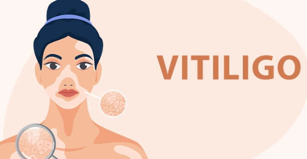 Immune Function and Vitiligo
