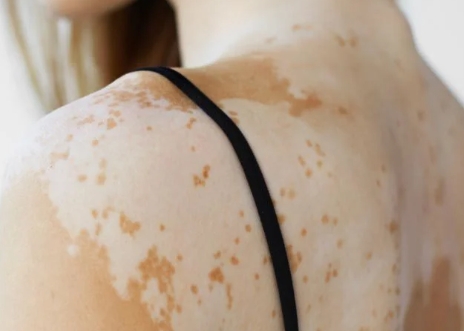 vitiligo causes