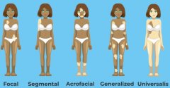 VITILIGO Causes, symptoms, types