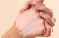 Does Vitiligo Related to Endocrine System