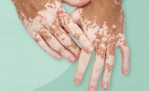 Vitiligo Causes,Symptoms,Diagnosis and Treatment