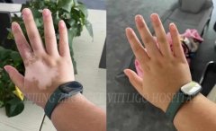 How to Treat Vitiligo on Hands