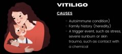 What are Causes of vitiligo
