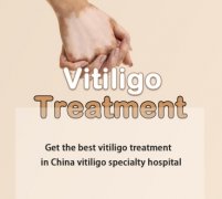 How to Cure Vitiligo Naturally 2025
