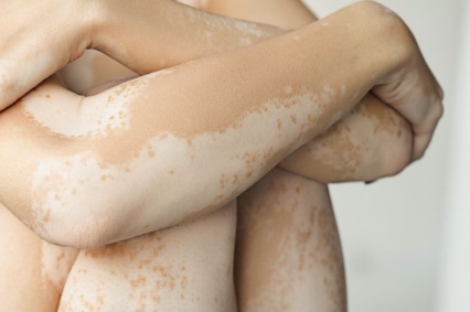 Causes of Vitiligo