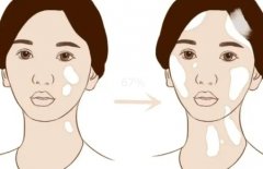 What Increases Your Risk for Vitiligo