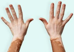  Daily health cares for vitiligo