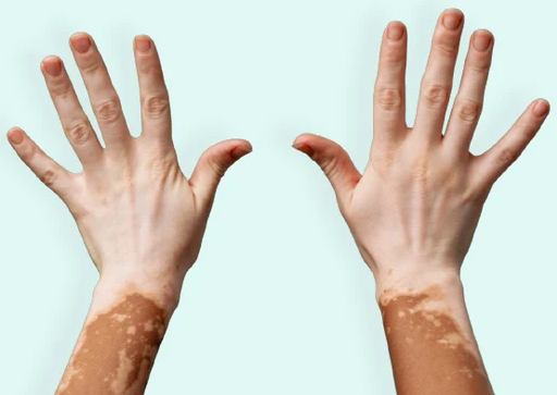  Daily health cares for vitiligo