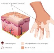 How does Vitiligo Start