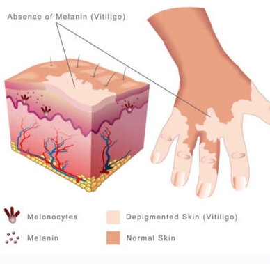 How does Vitiligo Start