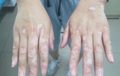  White Patches On Skin Causes, Symptoms