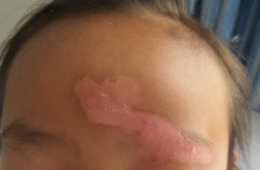 Early signs (symptoms) of Vitiligo