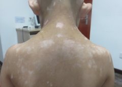 The pathology analyze of vitiligo