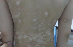 Top 5 Causes Of Vitiligo