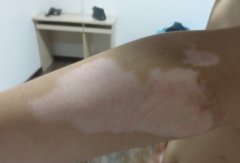 Best Top 3 Therapies for Vitiligo Patients