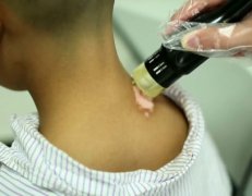 4 Factors Easy to Induce Vitiligo