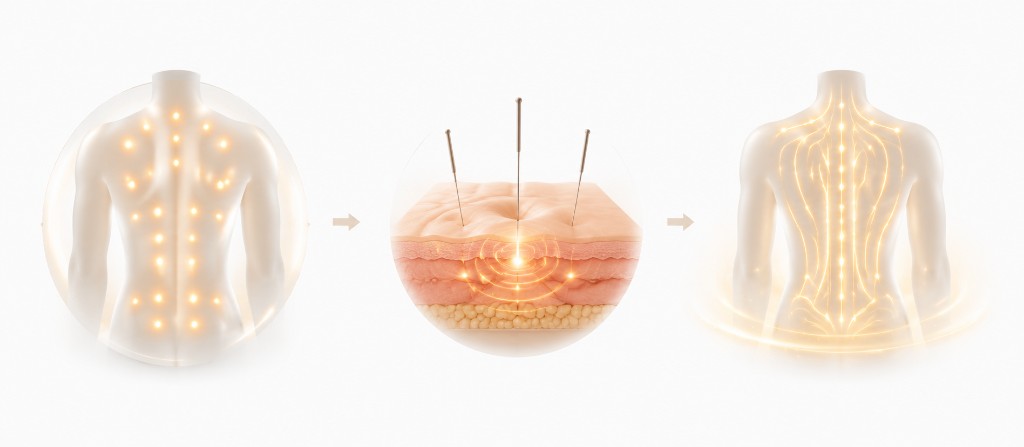 Acupoint Therapy