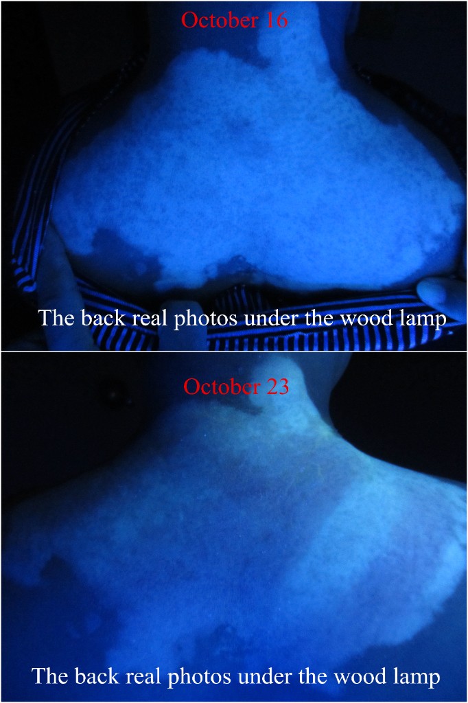 Wood's Lamp before-and-after comparison of treatment progress