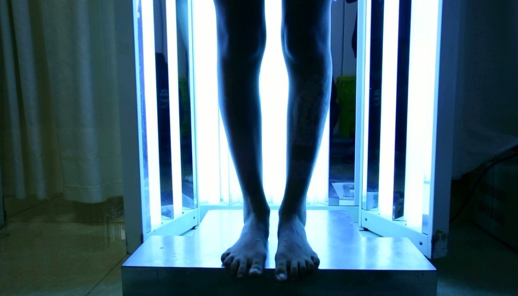Clinical UVB phototherapy of lower limbs